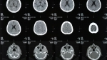 Foto de ¿Qué hace un paciente en un centro de neurorehabilitación?