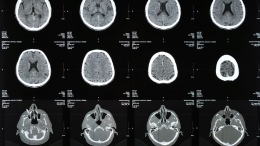 ¿Qué hace un paciente en un centro de neurorehabilitación?