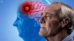 El Alzheimer: una enfermedad neurodegenerativa que requiere atención y cuidado