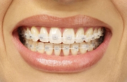 Ventajas de los Brackets Transparentes